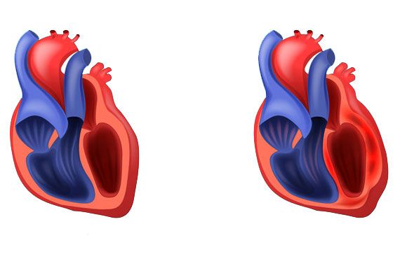 Illustration d'un coeur normal et d'un coeur souffrant d'une myocardite.